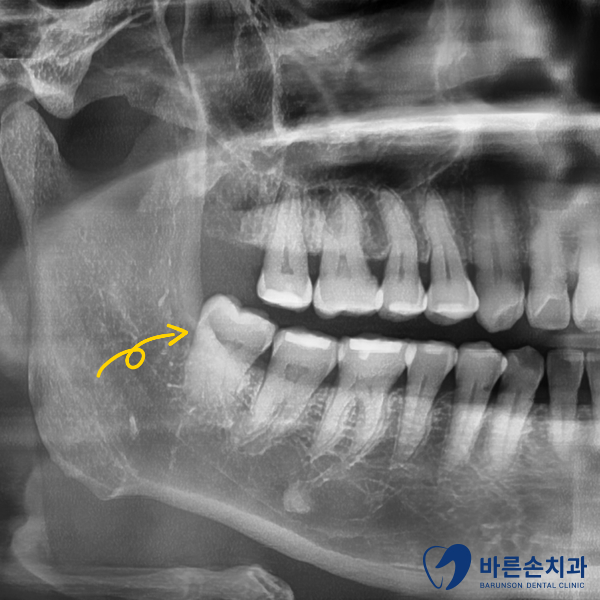 의정부임플란트