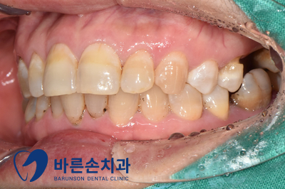 의정부임플란트