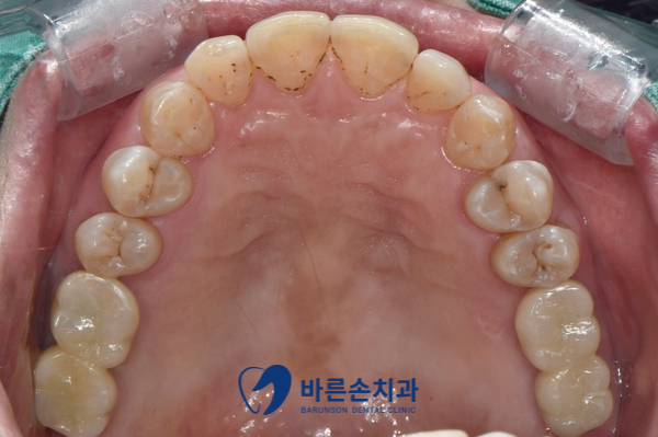 의정부임플란트