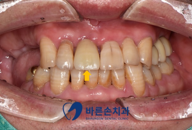신곡동임플란트