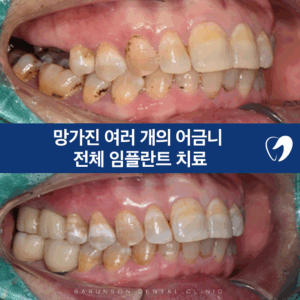 의정부임플란트