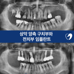 신곡동임플란트