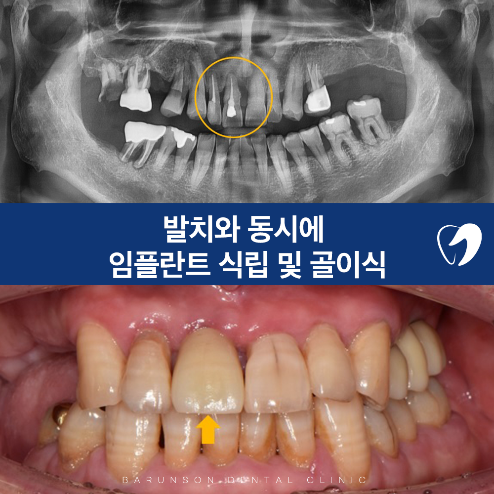 신곡동임플란트