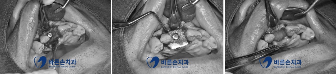 신곡동임플란트