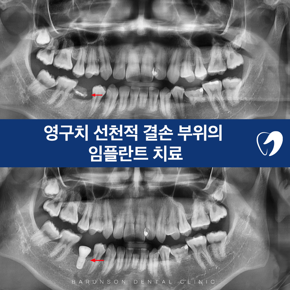 의정부임플란트