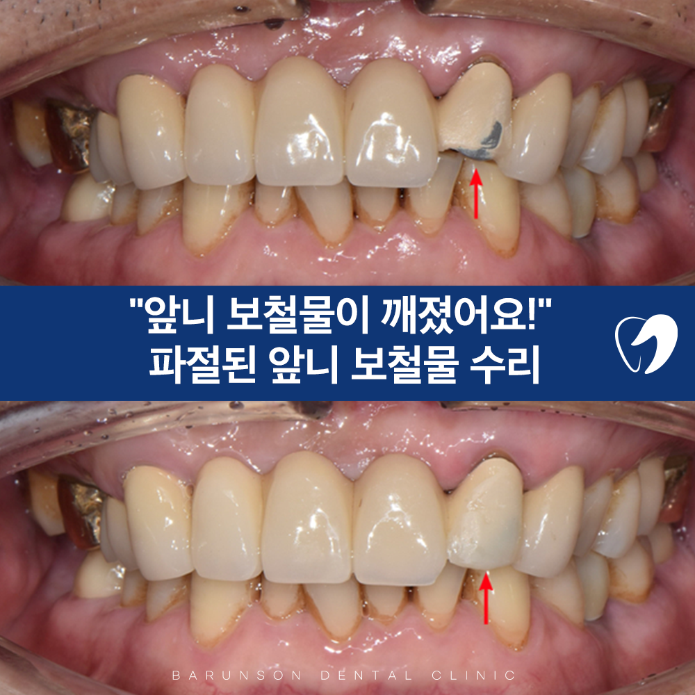 의정부임플란트