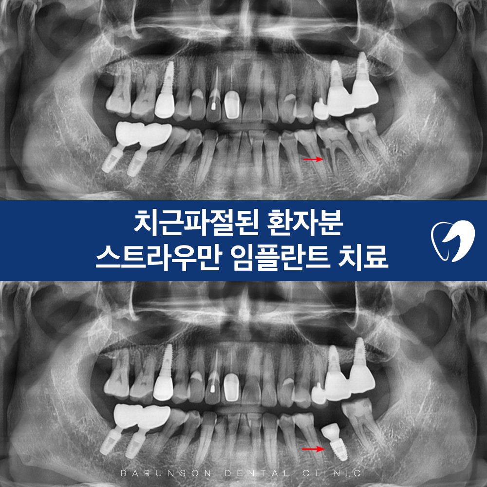 신곡동임플란트