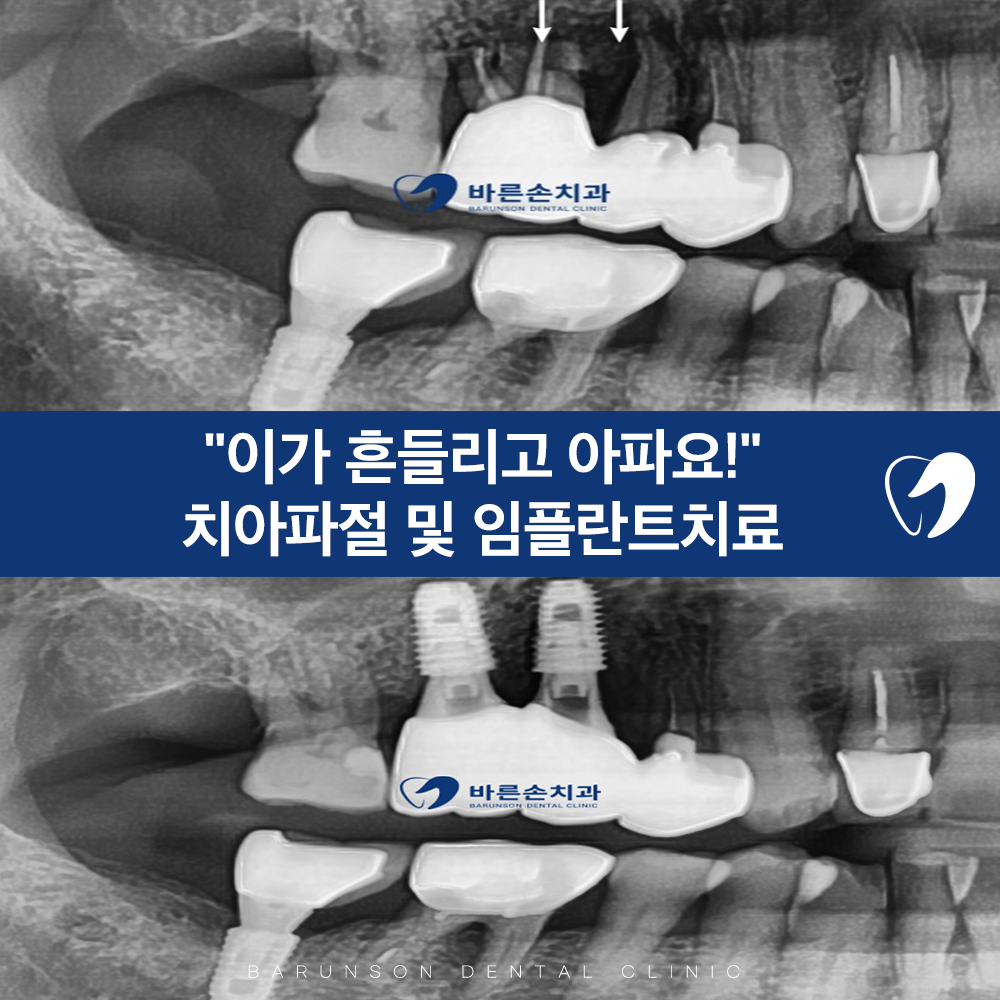 신곡동임플란트