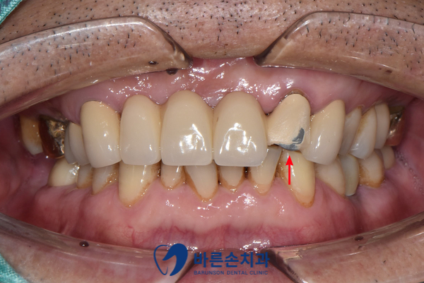 의정부임플란트