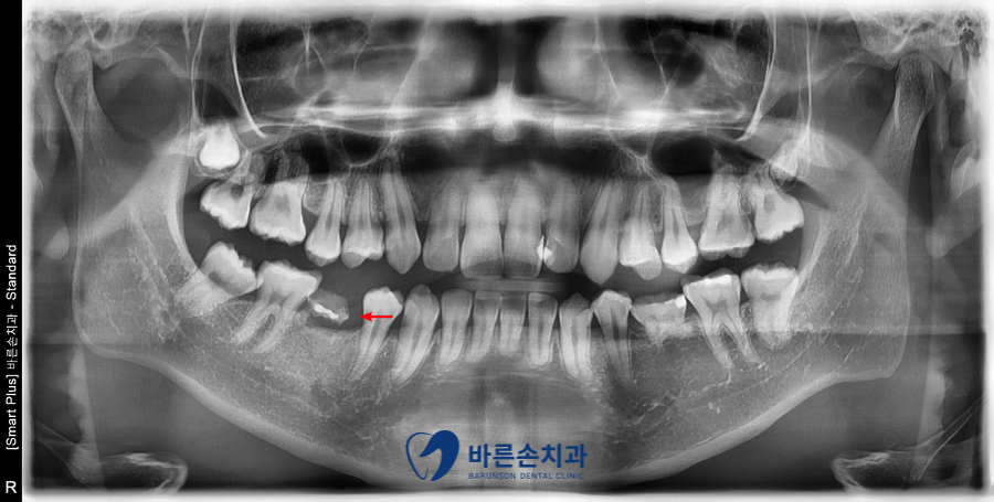 의정부임플란트