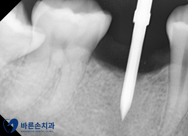 의정부임플란트