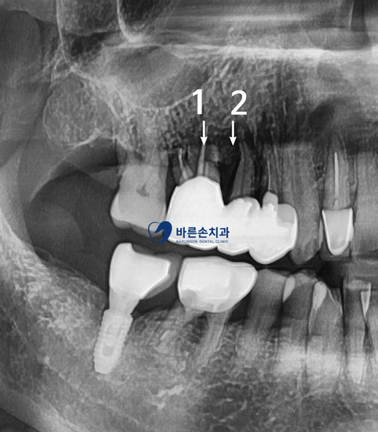 신곡동임플란트