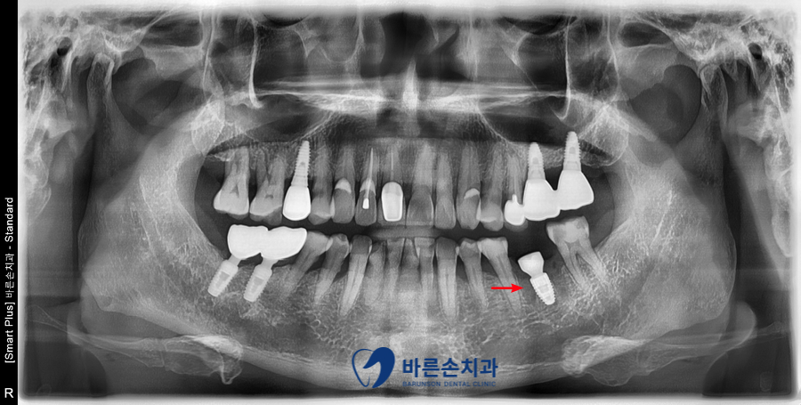 신곡동임플란트