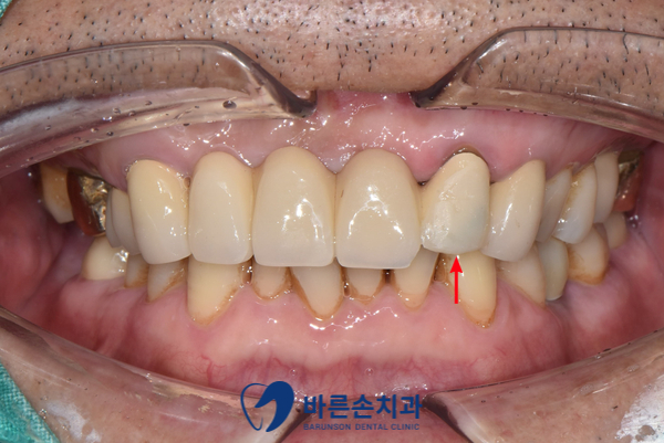 의정부임플란트