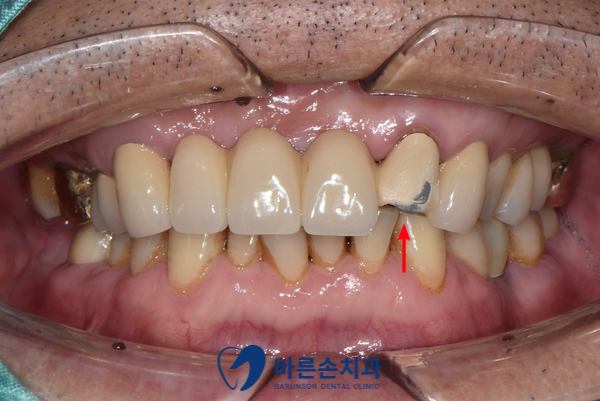 의정부임플란트
