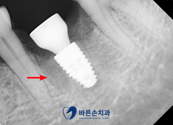 신곡동임플란트
