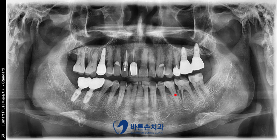 신곡동임플란트