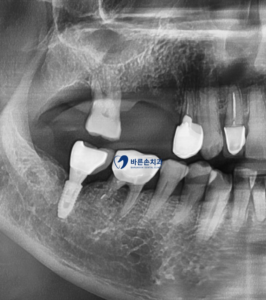 신곡동임플란트
