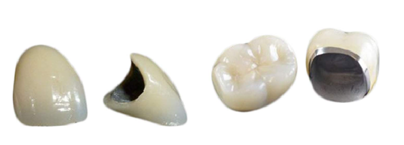 의정부임플란트