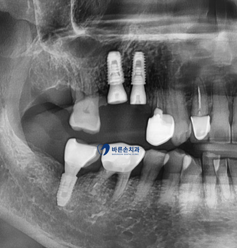 신곡동임플란트