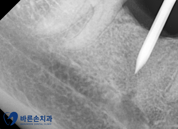 의정부임플란트