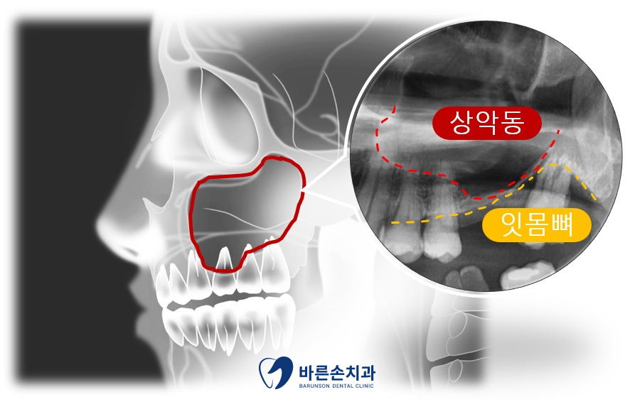 신곡동임플란트