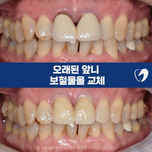 의정부임플란트
