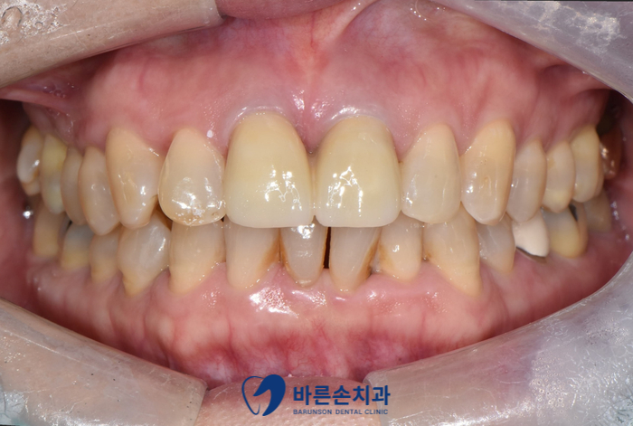 의정부임플란트