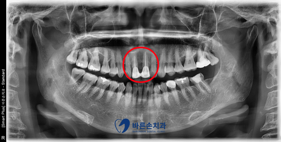 의정부임플란트