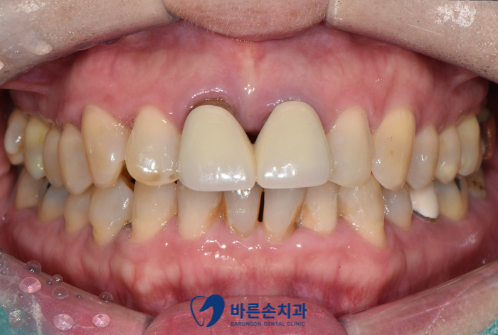 의정부임플란트