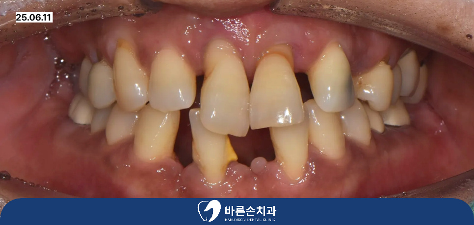 신곡동임플란트