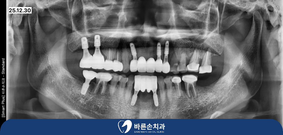 신곡동임플란트