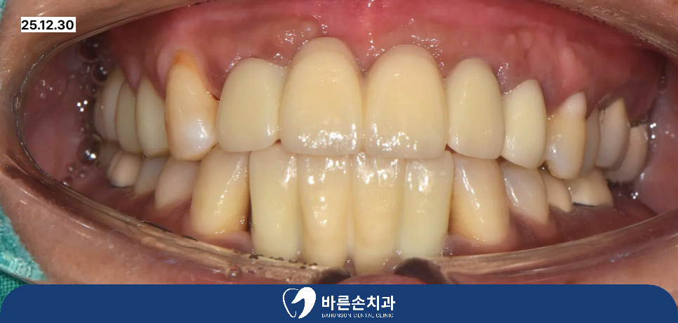 신곡동임플란트