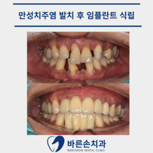 신곡동임플란트
