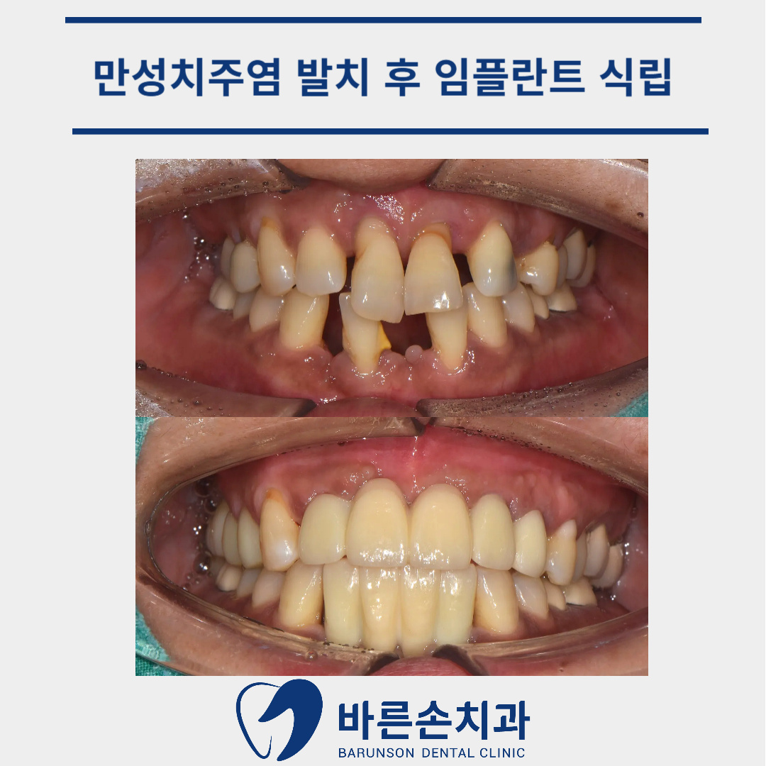 신곡동임플란트