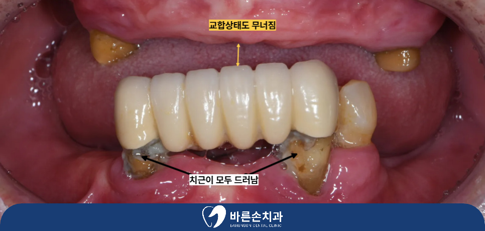 의정부임플란트