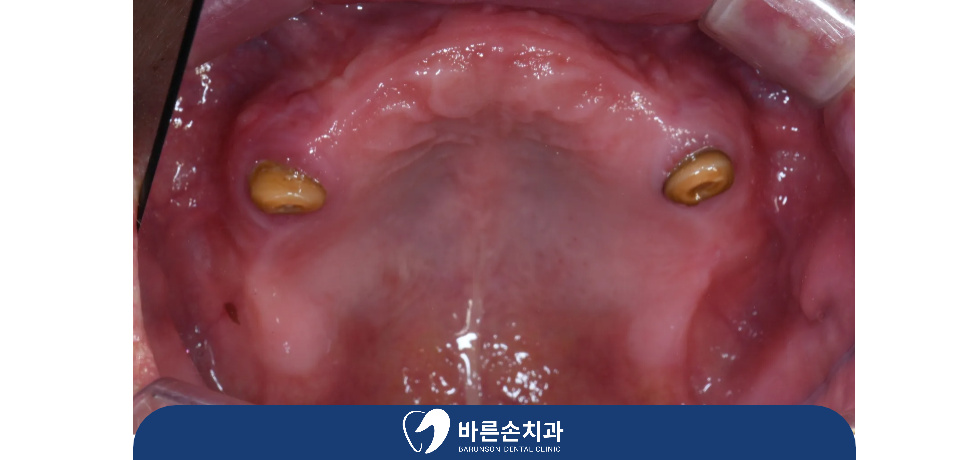 의정부임플란트