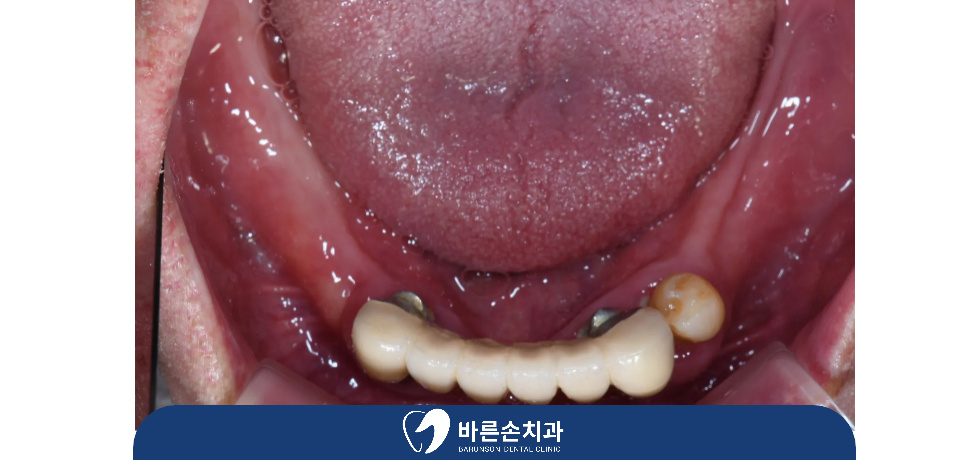 의정부임플란트