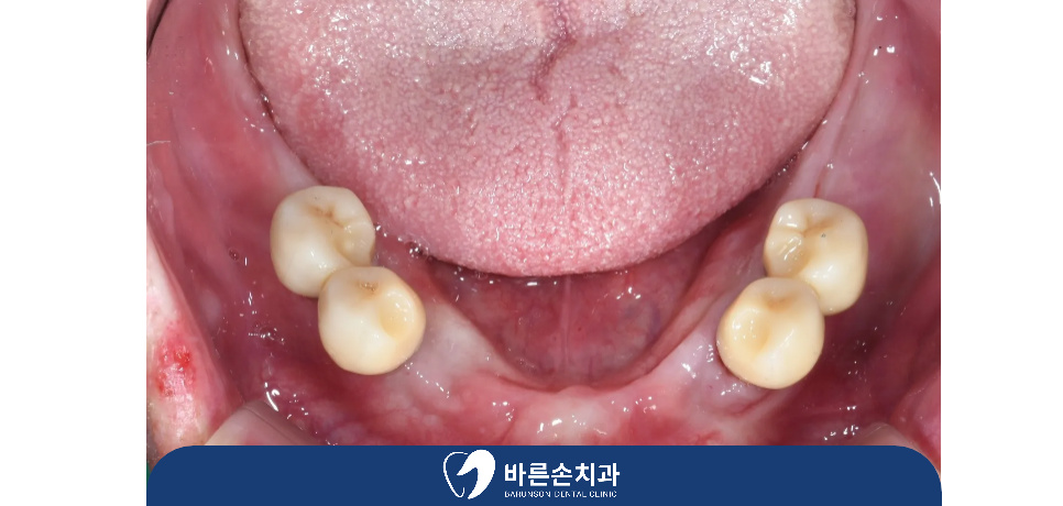 의정부임플란트