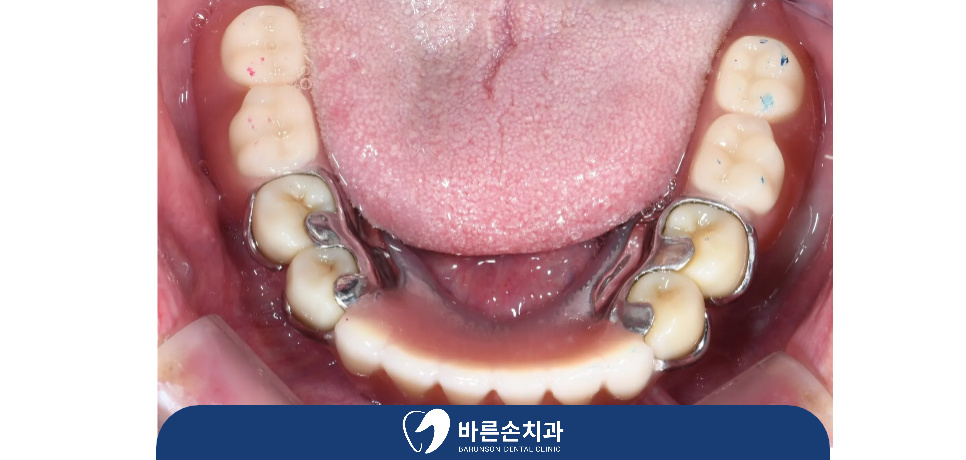 의정부임플란트