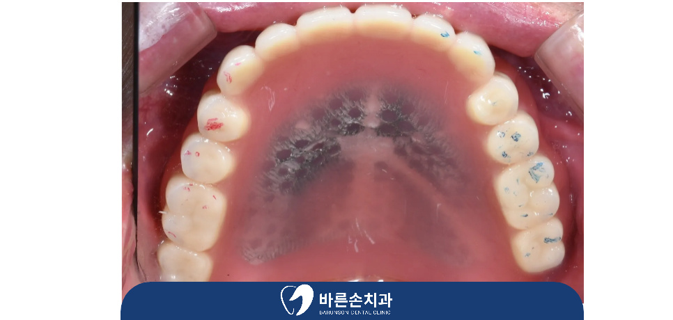의정부임플란트