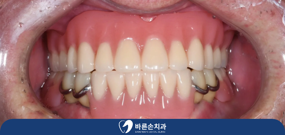 의정부임플란트