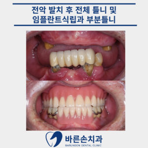 의정부임플란트