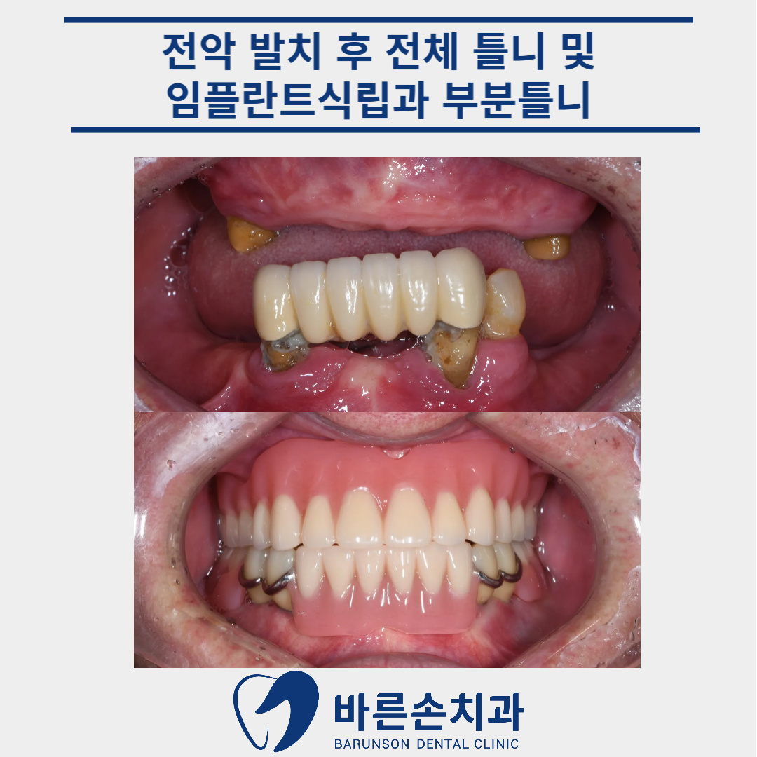 의정부임플란트